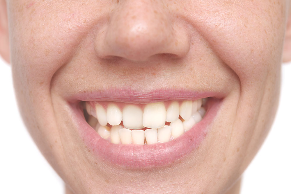 Crooked teeth can be from a calcium deficiency.