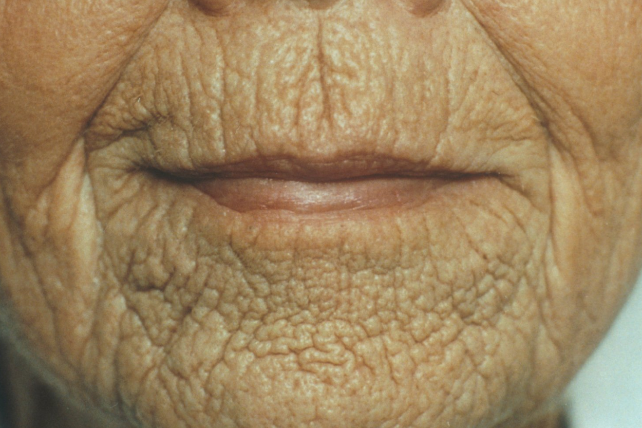 Wrinkles are a side effect of AGEs. Wrinkles are a side effect of AGEs.