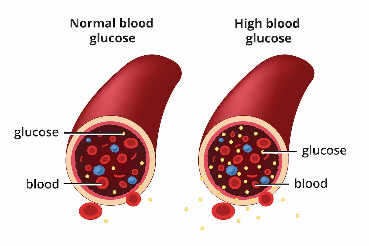Normal and high blood glucose or sugar. Normal and high blood glucose or sugar.