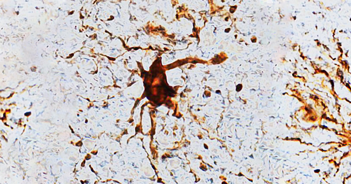 Picture of a zombie cell. Picture of a zombie cell.