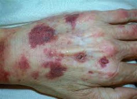 Bruising from scurvy.